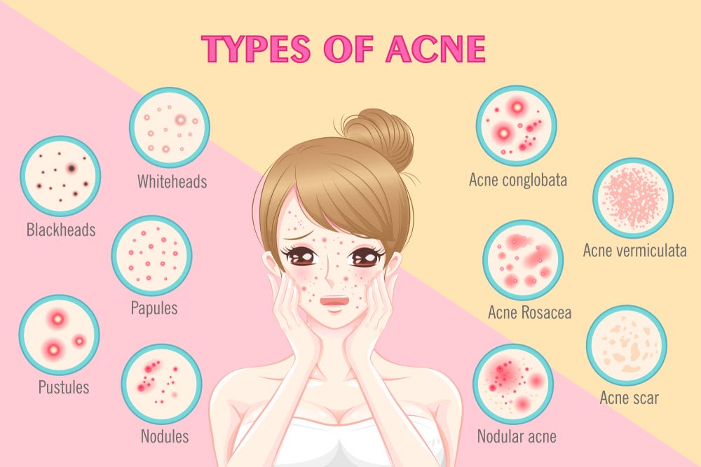 What is the hardest type of acne to treat?