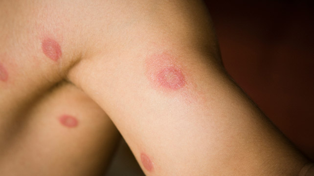 Understanding Fungal Skin Infections