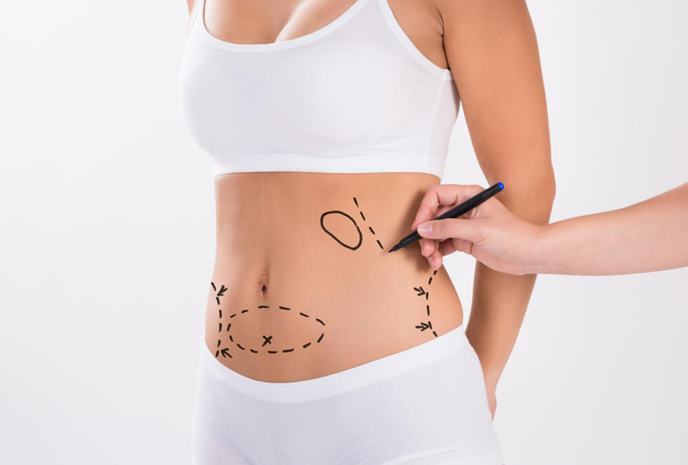 Importance of Surgeon Qualifications for Liposuction in Dubai