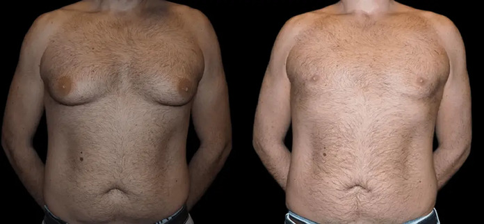 Advancements in Male Breast Reduction Surgery: Latest Techniques