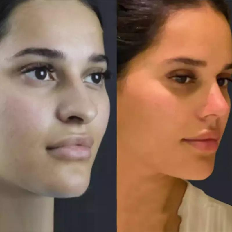 Rhinoplasty for Functional Improvement: Breathing Easier in Dubai